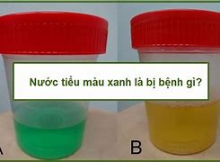 Nước Tiểu Màu Trong Suốt Là Bị Gì